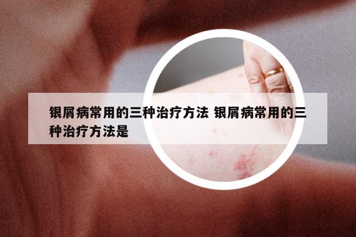 银屑病常用的三种治疗方法 银屑病常用的三种治疗方法是