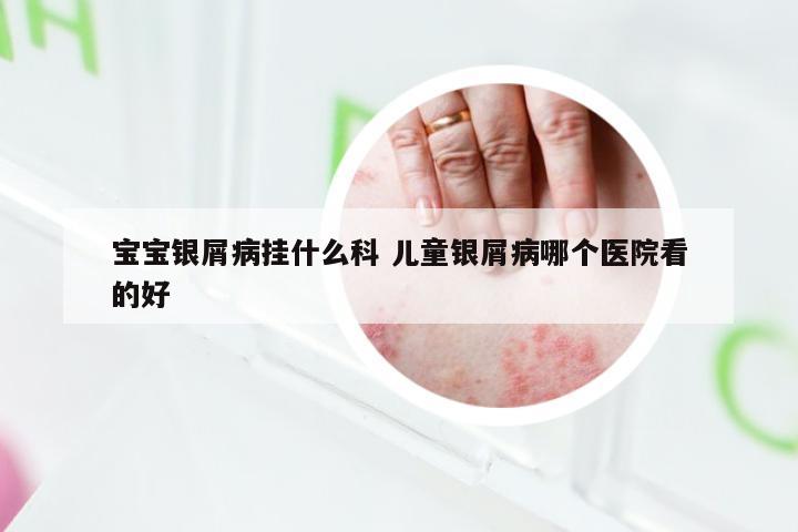 宝宝银屑病挂什么科 儿童银屑病哪个医院看的好