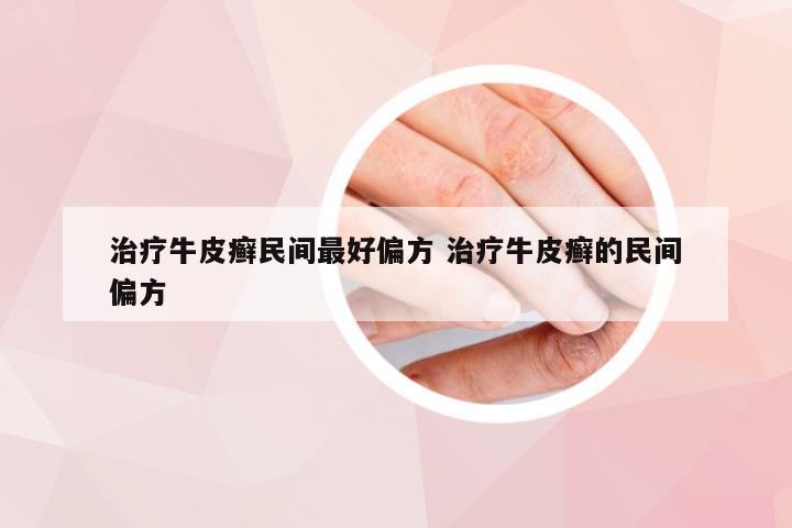 治疗牛皮癣民间最好偏方 治疗牛皮癣的民间偏方