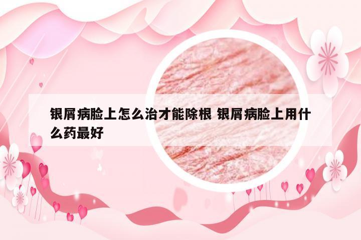 银屑病脸上怎么治才能除根 银屑病脸上用什么药最好