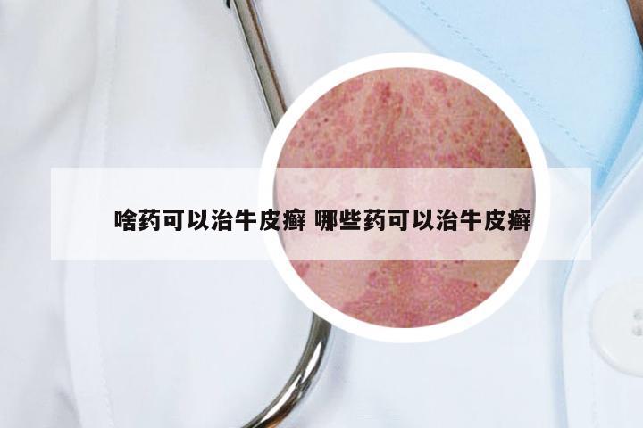 啥药可以治牛皮癣 哪些药可以治牛皮癣