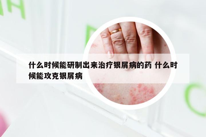 什么时候能研制出来治疗银屑病的药 什么时候能攻克银屑病