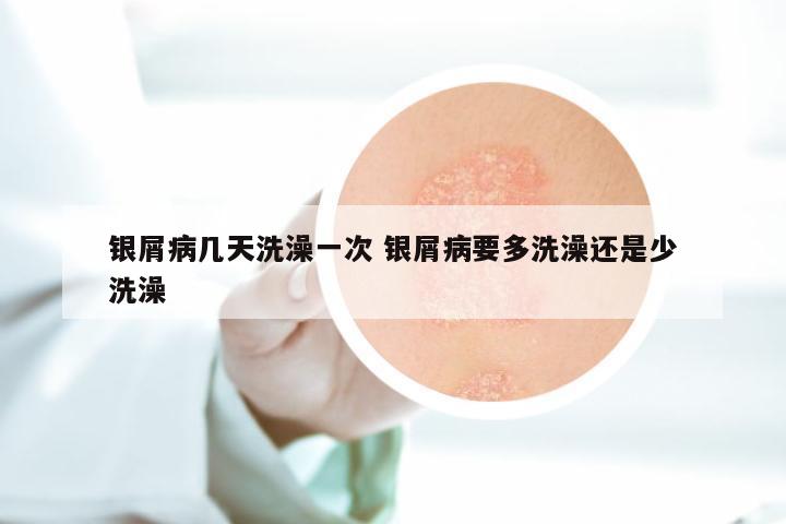 银屑病几天洗澡一次 银屑病要多洗澡还是少洗澡