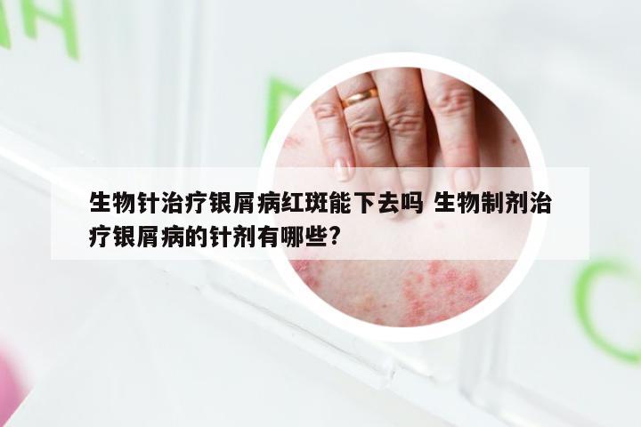 生物针治疗银屑病红斑能下去吗 生物制剂治疗银屑病的针剂有哪些?