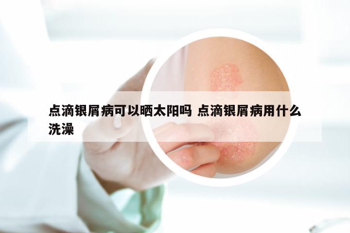点滴银屑病可以晒太阳吗 点滴银屑病用什么洗澡