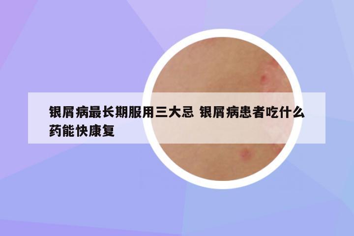 银屑病最长期服用三大忌 银屑病患者吃什么药能快康复