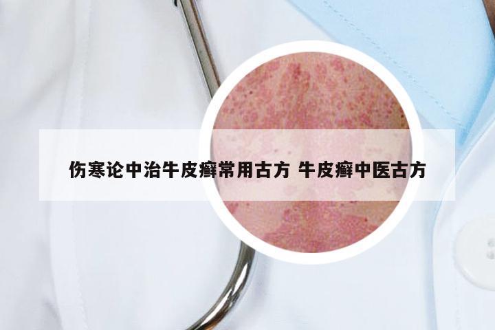 伤寒论中治牛皮癣常用古方 牛皮癣中医古方