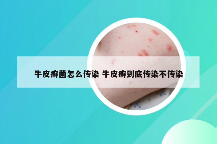 牛皮癣菌怎么传染 牛皮癣到底传染不传染