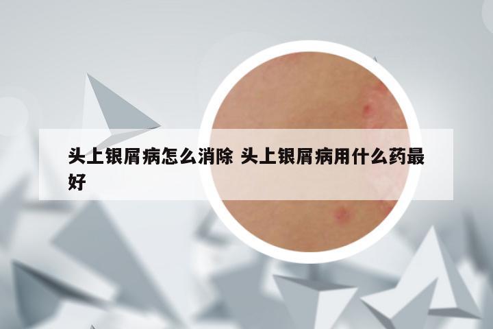 头上银屑病怎么消除 头上银屑病用什么药最好