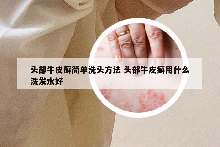 头部牛皮癣简单洗头方法 头部牛皮癣用什么洗发水好