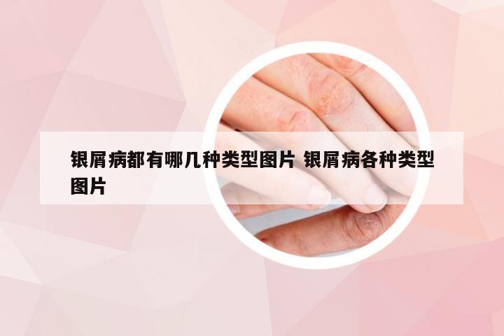 银屑病都有哪几种类型图片 银屑病各种类型图片