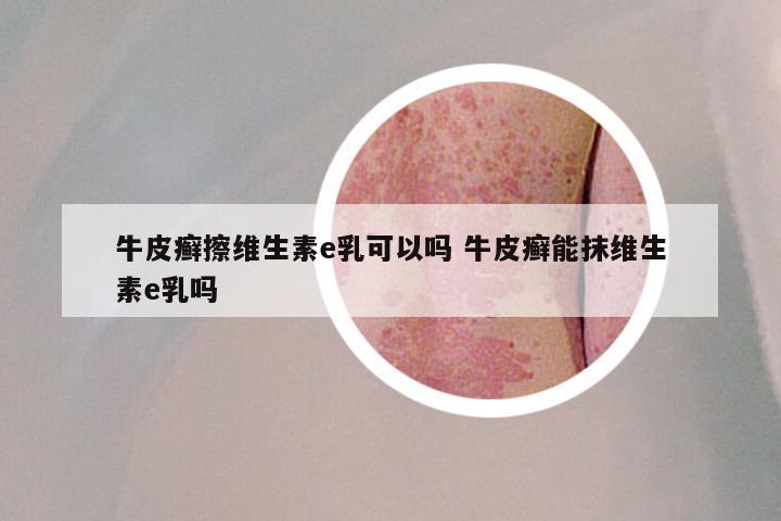 牛皮癣擦维生素e乳可以吗 牛皮癣能抹维生素e乳吗