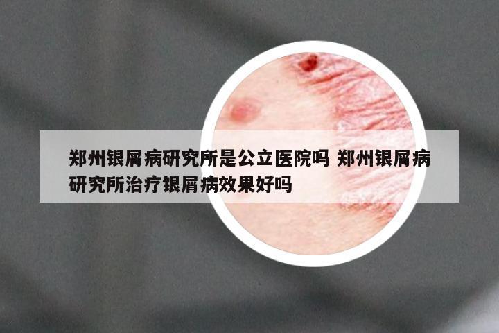 郑州银屑病研究所是公立医院吗 郑州银屑病研究所治疗银屑病效果好吗