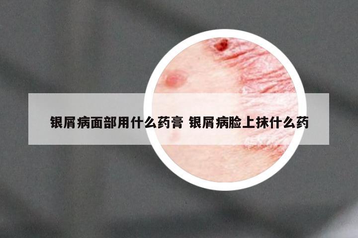 银屑病面部用什么药膏 银屑病脸上抹什么药
