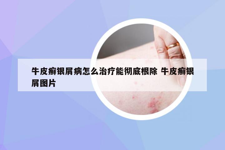 牛皮癣银屑病怎么治疗能彻底根除 牛皮癣银屑图片