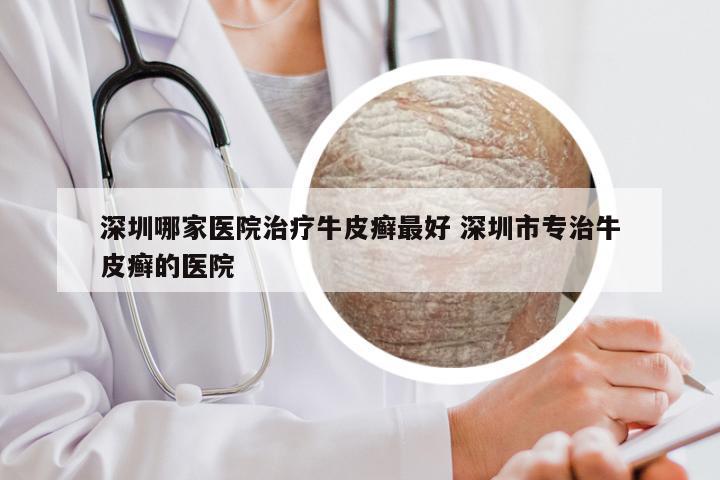 深圳哪家医院治疗牛皮癣最好 深圳市专治牛皮癣的医院