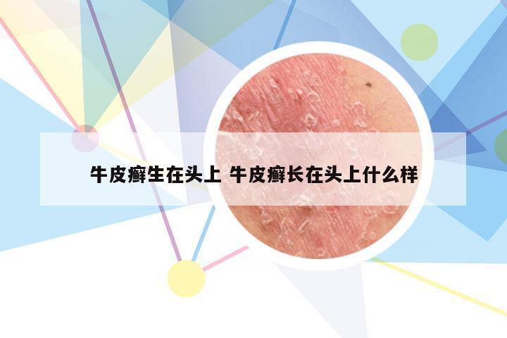 牛皮癣生在头上 牛皮癣长在头上什么样