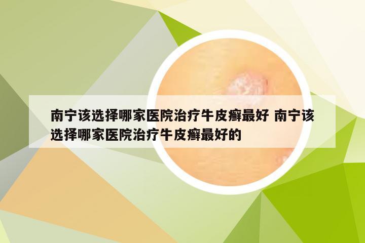 南宁该选择哪家医院治疗牛皮癣最好 南宁该选择哪家医院治疗牛皮癣最好的