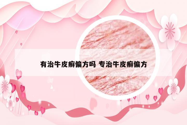 有治牛皮癣偏方吗 专治牛皮癣偏方