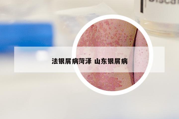 法银屑病菏泽 山东银屑病