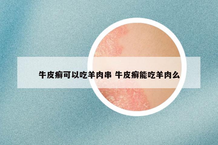 牛皮癣可以吃羊肉串 牛皮癣能吃羊肉么
