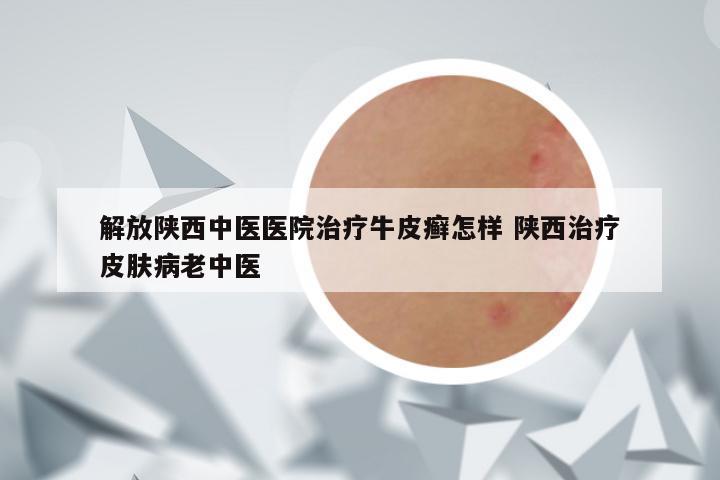解放陕西中医医院治疗牛皮癣怎样 陕西治疗皮肤病老中医