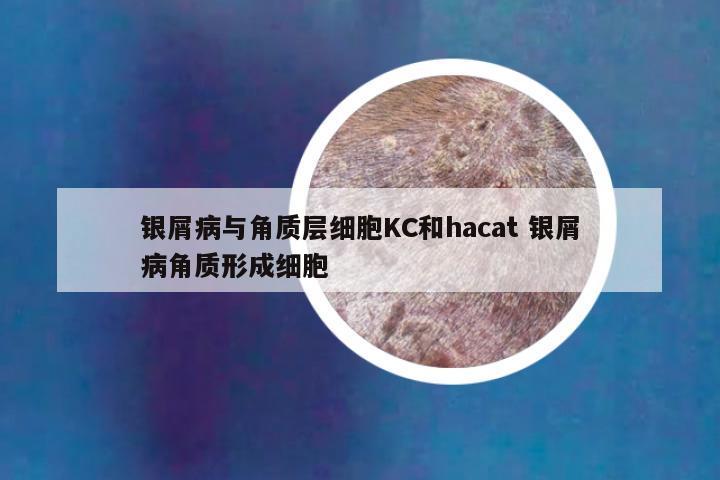 银屑病与角质层细胞KC和hacat 银屑病角质形成细胞