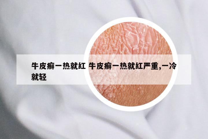 牛皮癣一热就红 牛皮癣一热就红严重,一冷就轻