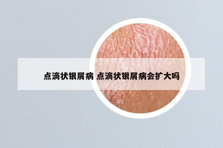 点滴状银屑病 点滴状银屑病会扩大吗
