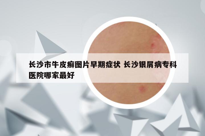 长沙市牛皮癣图片早期症状 长沙银屑病专科医院哪家最好