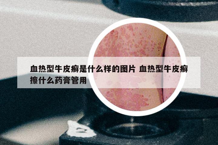 血热型牛皮癣是什么样的图片 血热型牛皮癣擦什么药膏管用