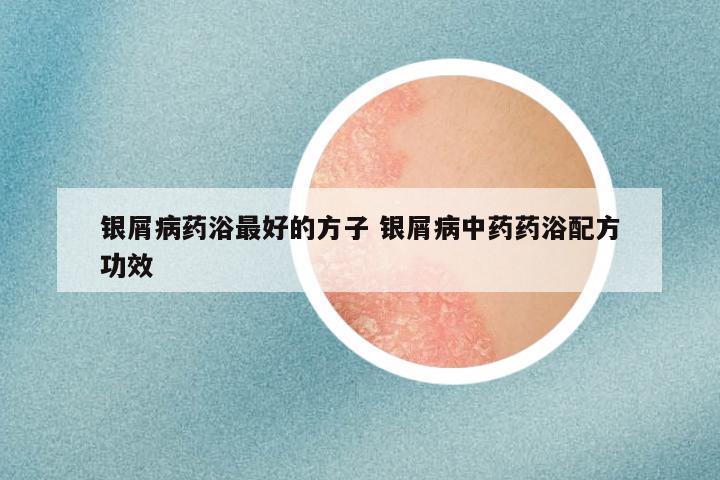 银屑病药浴最好的方子 银屑病中药药浴配方功效