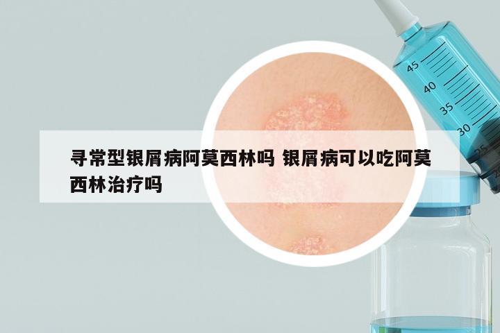 寻常型银屑病阿莫西林吗 银屑病可以吃阿莫西林治疗吗