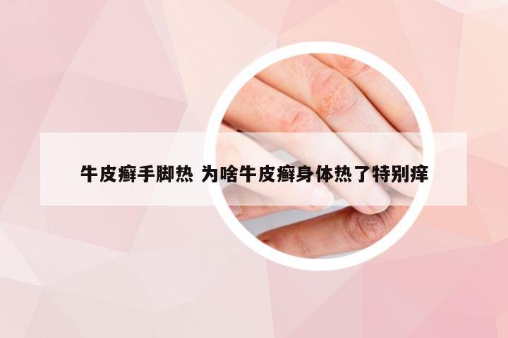 牛皮癣手脚热 为啥牛皮癣身体热了特别痒