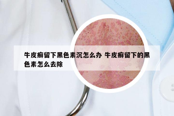 牛皮癣留下黑色素沉怎么办 牛皮癣留下的黑色素怎么去除