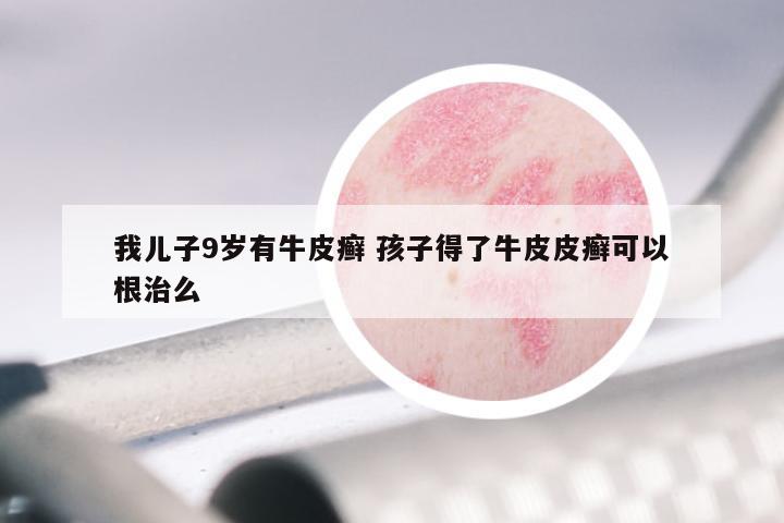 我儿子9岁有牛皮癣 孩子得了牛皮皮癣可以根治么
