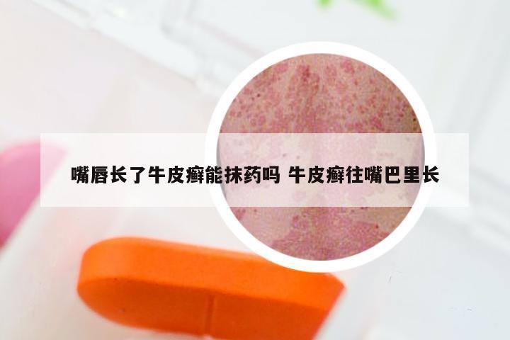 嘴唇长了牛皮癣能抹药吗 牛皮癣往嘴巴里长