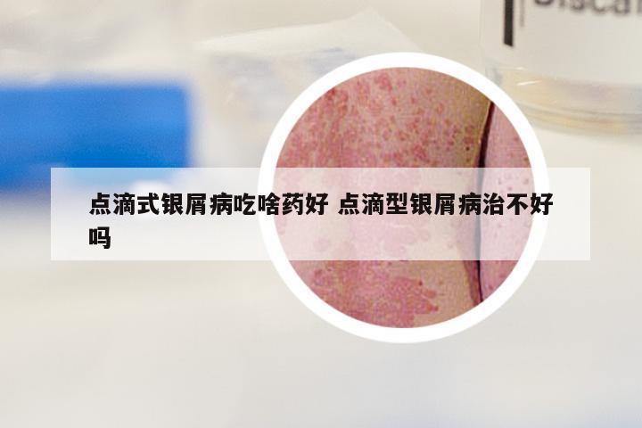 点滴式银屑病吃啥药好 点滴型银屑病治不好吗