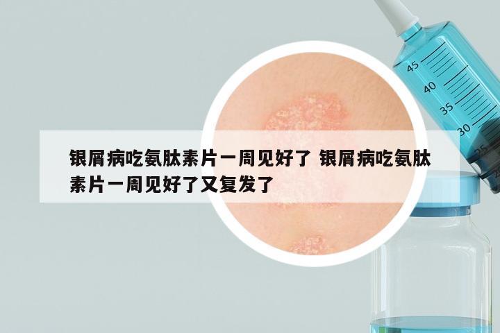 银屑病吃氨肽素片一周见好了 银屑病吃氨肽素片一周见好了又复发了