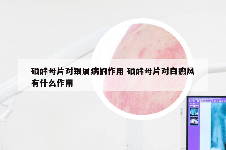 硒酵母片对银屑病的作用 硒酵母片对白癜风有什么作用