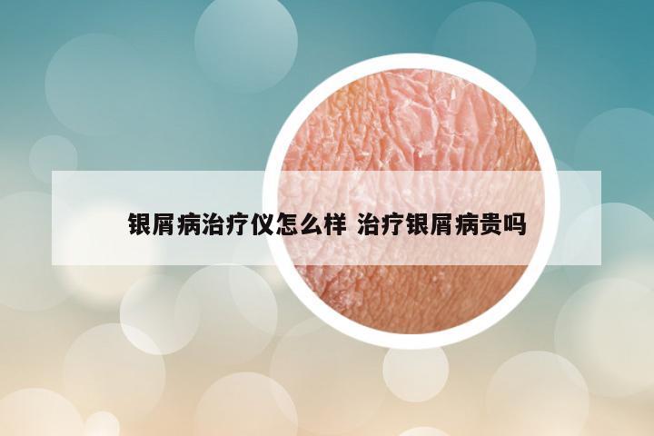 银屑病治疗仪怎么样 治疗银屑病贵吗