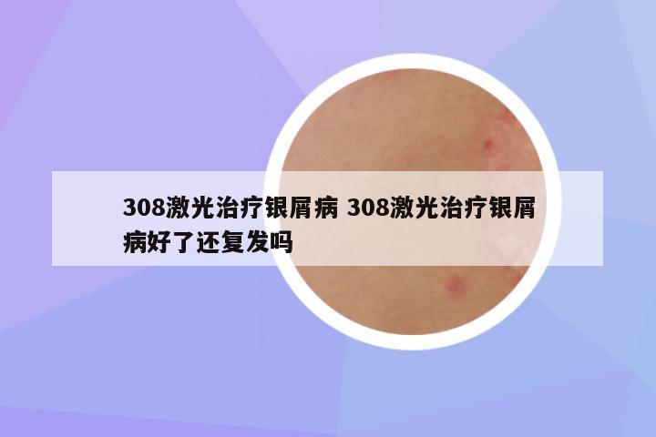 308激光治疗银屑病 308激光治疗银屑病好了还复发吗