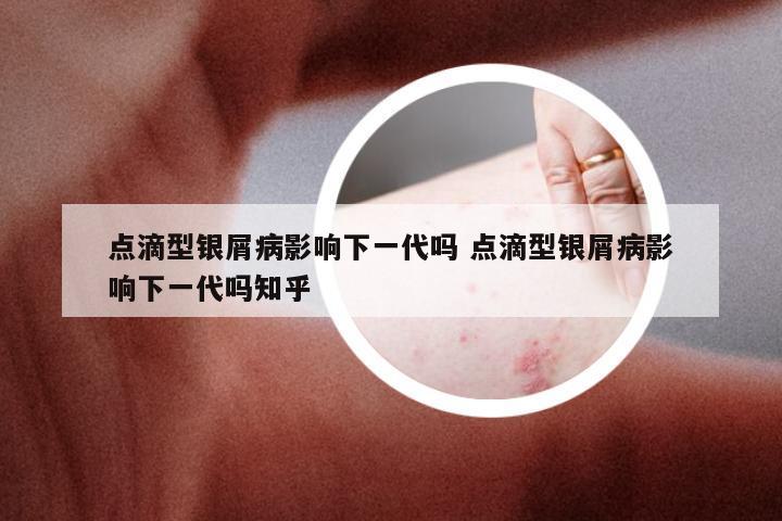 点滴型银屑病影响下一代吗 点滴型银屑病影响下一代吗知乎