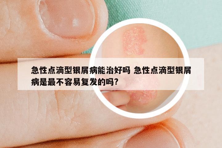急性点滴型银屑病能治好吗 急性点滴型银屑病是最不容易复发的吗?