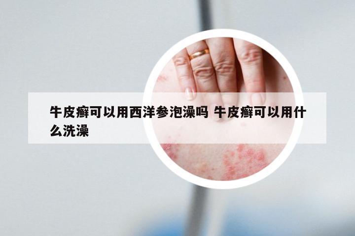 牛皮癣可以用西洋参泡澡吗 牛皮癣可以用什么洗澡