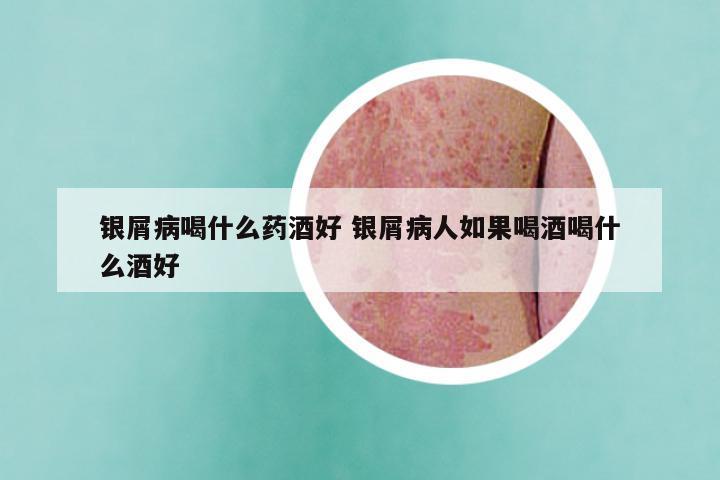 银屑病喝什么药酒好 银屑病人如果喝酒喝什么酒好