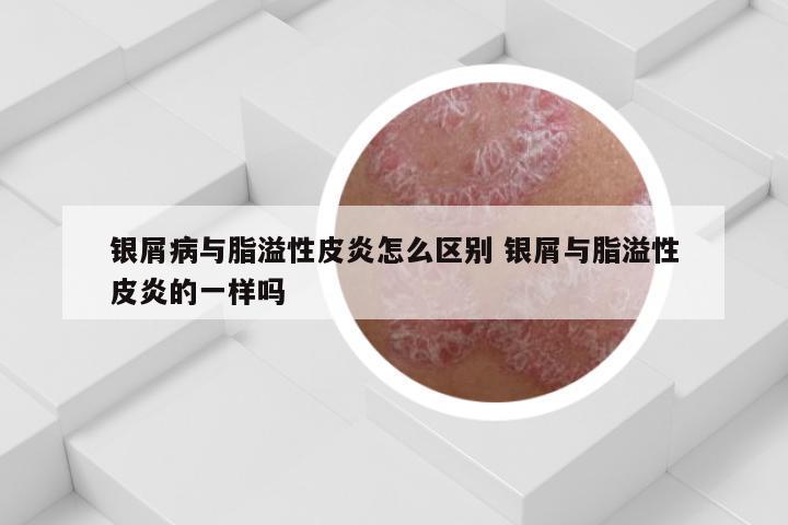 银屑病与脂溢性皮炎怎么区别 银屑与脂溢性皮炎的一样吗