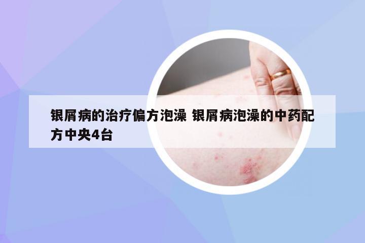 银屑病的治疗偏方泡澡 银屑病泡澡的中药配方中央4台