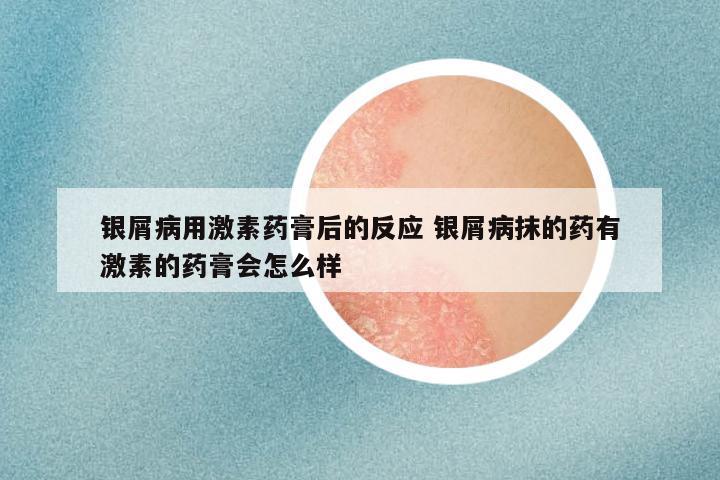 银屑病用激素药膏后的反应 银屑病抹的药有激素的药膏会怎么样
