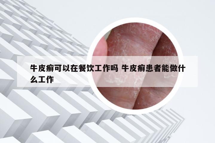 牛皮癣可以在餐饮工作吗 牛皮癣患者能做什么工作